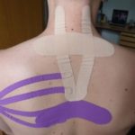 Kineziotaping – cesta regenerace a rehabilitace